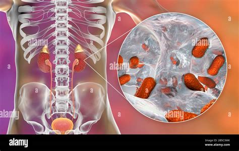 Acute Pyelonephritis Caused By Acinetobacter Bacteria Illus Stock