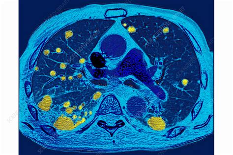 Lung Metastases, CT Scan - Stock Image - C030/6799 - Science Photo Library