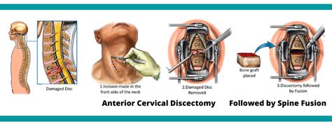 Anterior Cervical Discectomy Fusion Female Order Ubicaciondepersonas Cdmx Gob Mx