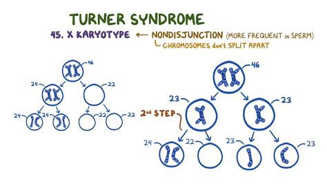 Turner syndrome: Year of the Zebra: Video & Anatomy | Osmosis