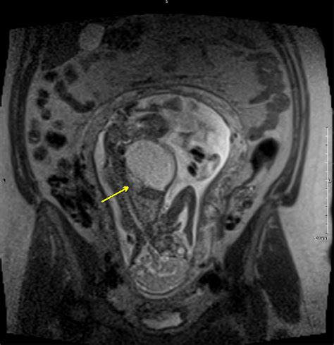 Prenatal MRI At Week 22 Of Gestation Showing Coronal Image Of The