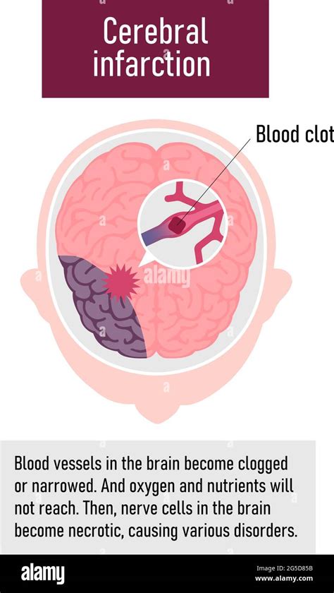 Types Of Human Brain Stroke Vector Illustration Cerebral Infarction