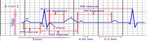 How To Calculate Qrs Interval