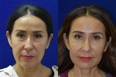 Chemical Peels Before And After Pictures Photos Beverly Hills Los