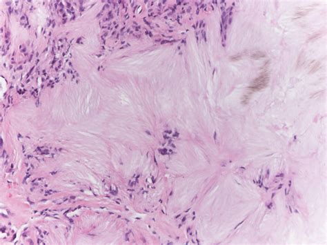 Multiple Nontender Subcutaneous Nodules On The Finger Mdedge Dermatology