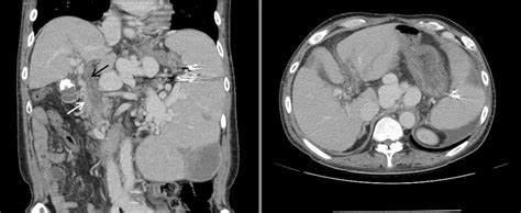 A Abdomen Computed Tomography Ct Scan Shows The Development Of