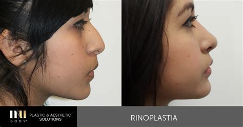 Cuanto Vale Una Rinoplastia En Colombia Elna Cassondra