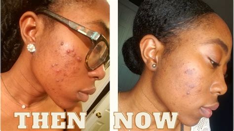 How I Naturally Cleared My Cystic Acne Youtube