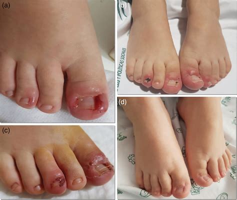 Toenail Removal Before And After