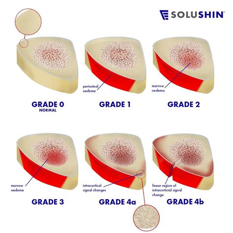 Shin Splints Infographic