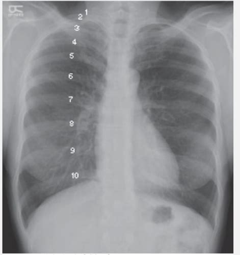 Chest X Rays Flashcards Quizlet