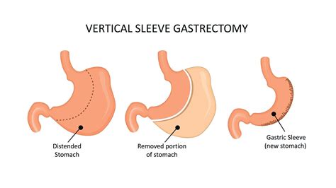 Vertical Sleeve Gastrectomy