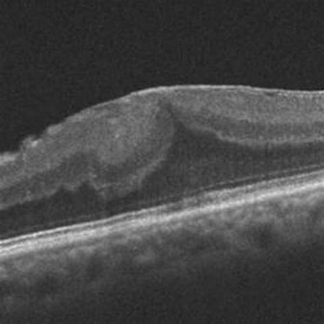 Epiretinal Membrane Oct