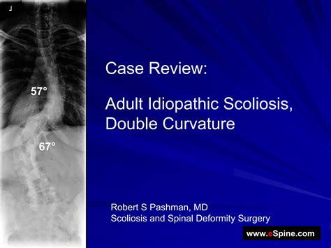 Case Review 9 Adult Idiopathic Scoliosis With A Double Curvature Ppt