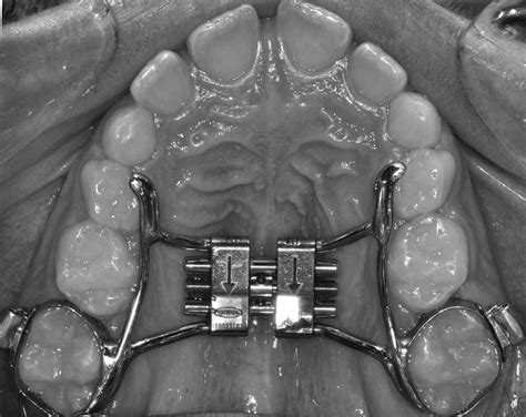 Rapid Maxillary Expansion Rme Appliance Download Scientific Diagram