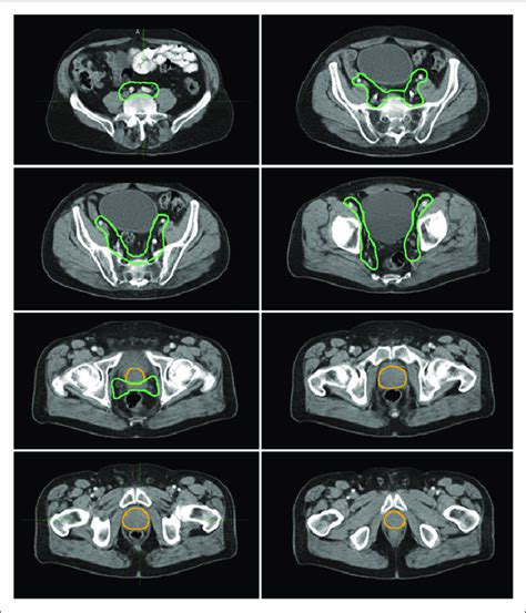 Axial Ct Views Of Prostate Ctv Yellow And Of Pelvic Ln And Seminal Download Scientific