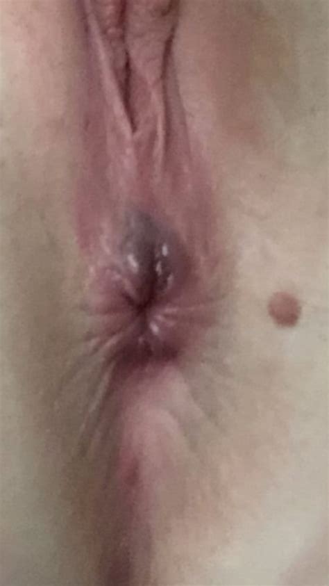 Small Spot In Vagina Sex Photos