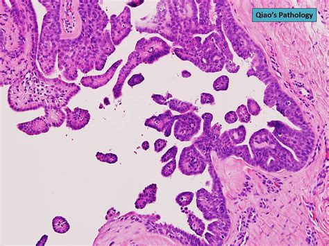 Qiao S Pathology Digital Papillary Carcinoma Microscopic Flickr