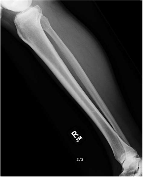 A Year Old Man With Worsening Calf Pain Jbjs Image Quiz