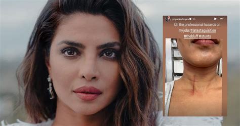 Priyanka Chopra Suffers Injury On Sets Of ‘the Bluff Shows Massive