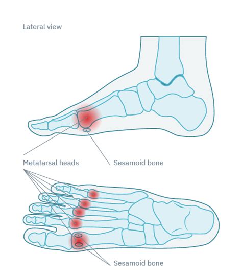 Metatarsalgia Causes Pain In The Ball Of The Foot