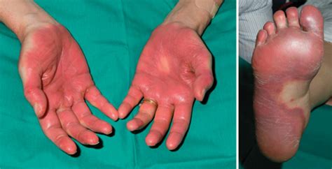 Hand–foot syndrome after treatment with docetaxel | The Medical Journal ...