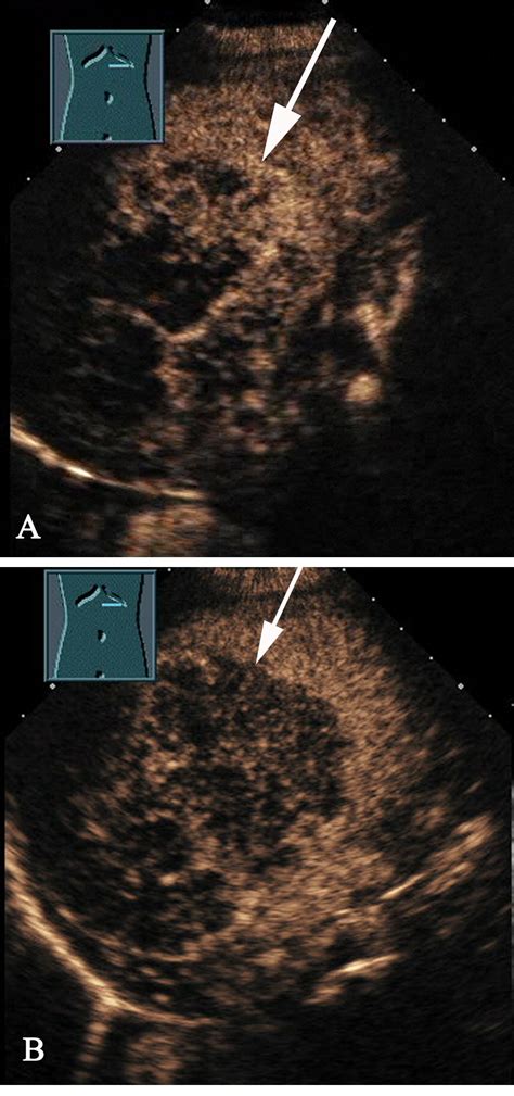 Real Time Contrast Enhanced Ultrasound In Diagnosing Of Focal Spleen Lesions European Journal