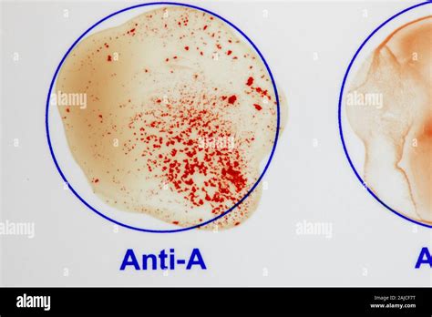 Nahaufnahme Von Home Abo Blutgruppe Test Kit Zeigen Ergebnisse Des