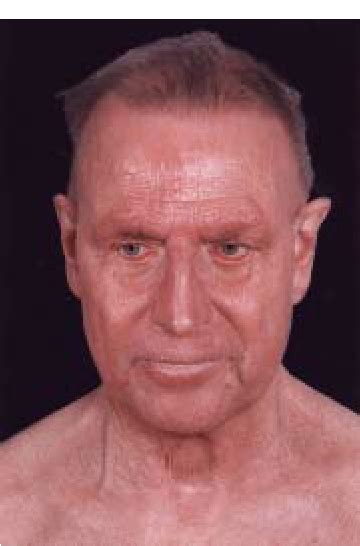 Patient With Cutaneous T Cell Lymphoma S Zary Syndrome Showing