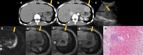 A 27 Year Old Woman With Splenosis She Had A History Of Splenectomy