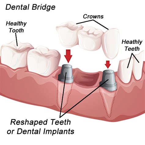 Dental Bridges Spring TX | Spring Complete Care Dentistry