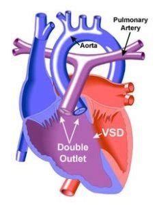 Double Outlet Right Ventricle (DORV) - Tiny Tickers