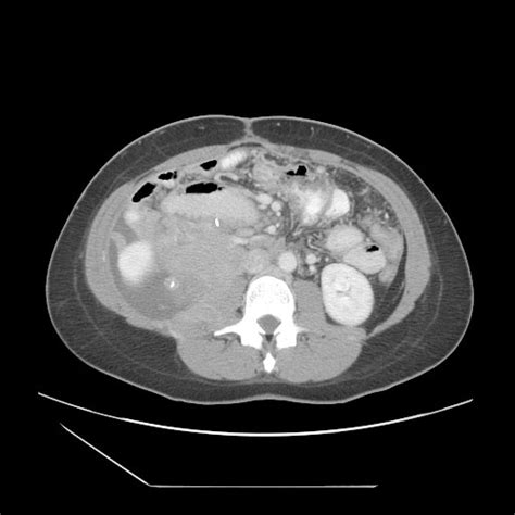 Liposarcoma | Image | Radiopaedia.org