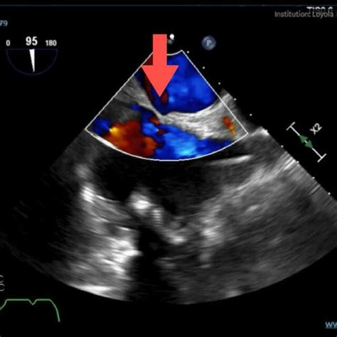 Midesophageal Bicaval View After Second Cpb Red Arrow Denotes Fossa