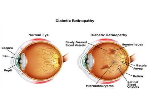 Best Retinopathy Treatment in Kerala | Top Eye Specialists in Kerala