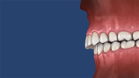 Overbite Explained: Causes, Symptoms, Treatment - Henry Advanced ...