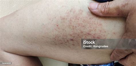 infeksi  ruam gatalgatal  kulit gatal  kaki tergores