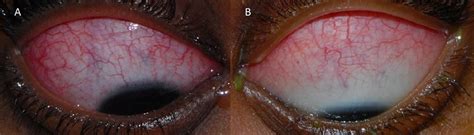 Infliximab For Management Of Severe Refractory Posterior Scleritis In A