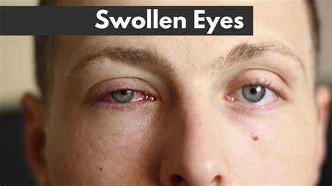 Swollen Eyes Explained Dorio Eyecare 41 Off