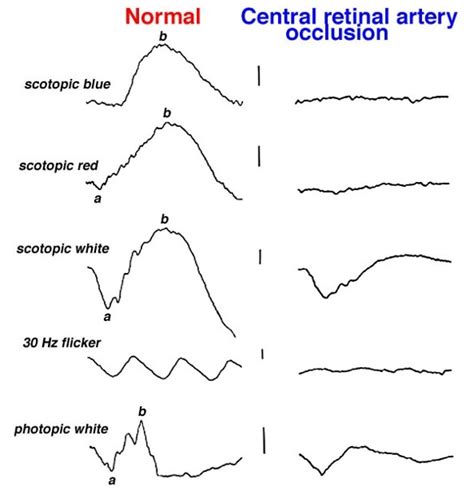 Figure 28b ERGs In A Patient With Central Retinal Artery Occlusion