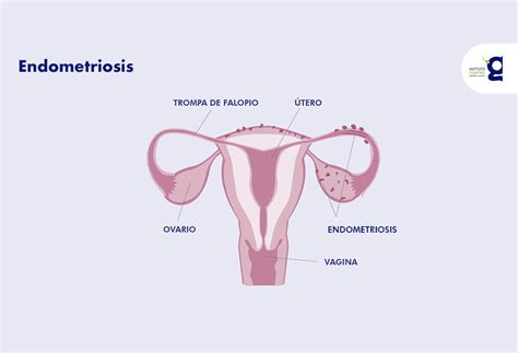 Endometriosis Qu Es Y C Mo Afecta A La Fertilidad Ingenes Sexiz Pix