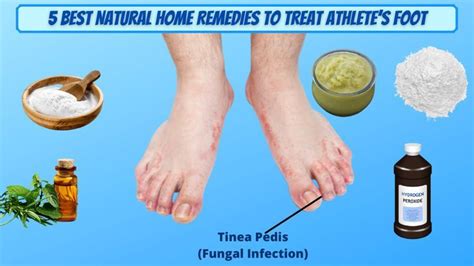 5 best natural home remedies for athlete s foot how to get rid of ...