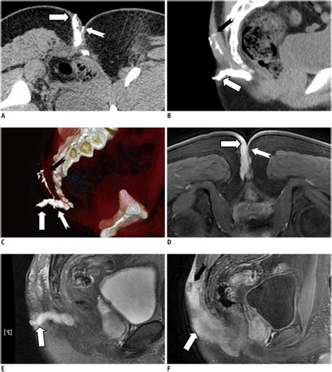 Imaging Of Anal Fistulas Comparison Of Computed Tomographic