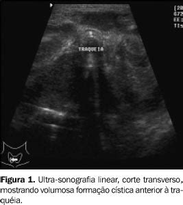 Radiologia Brasileira Tireoidite Bacteriana Supurativa Relato De