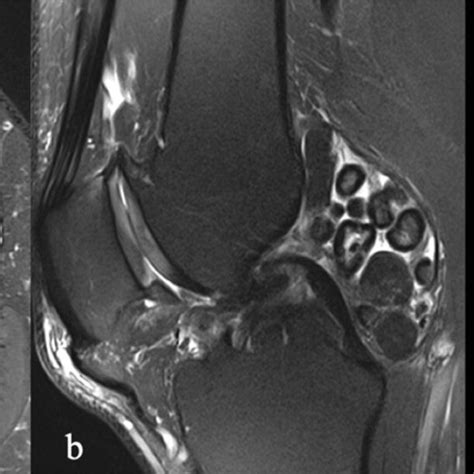 a MRI axial view and b MRI sagittal view. Chondropathy, minimal ...