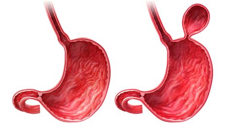 Hernia De Hiato Qu Es Causas S Ntomas Y Tratamientos