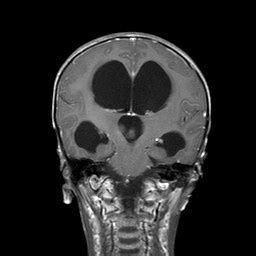 Pineoblastoma | Image | Radiopaedia.org