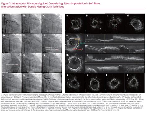 Intravascular Ultrasound Guided Drug Eluting Stents Implantation