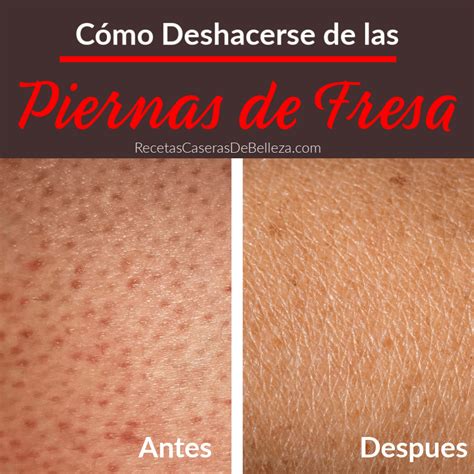 Cómo Deshacerse De Las Piernas De Fresa Exfoliante De Piernas Maquinilla De Afeitar Remedios