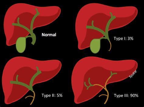 Figure 1 From Congenital Biliary Tract Disease Semantic Scholar